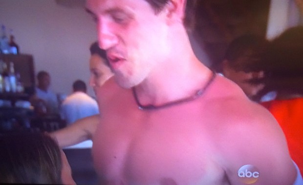 justin sunburn bachelor